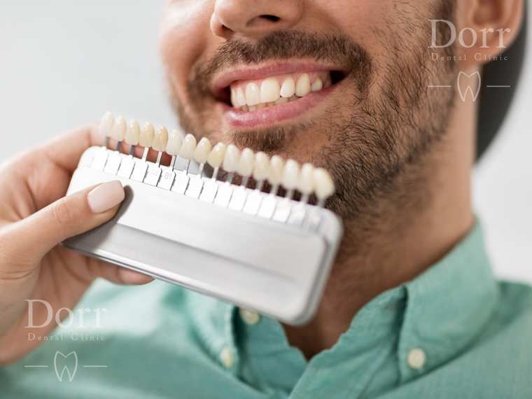 Are dental veneers worth it