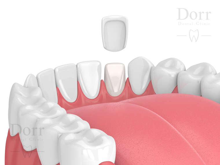 Veneer placement procedure