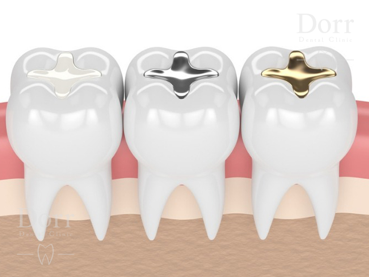 Dental inlays