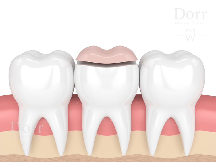 Dental onlay