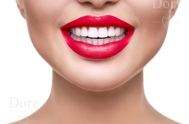 right candidate for dental veneers