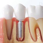 Dental implant