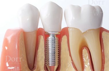 Dental implant