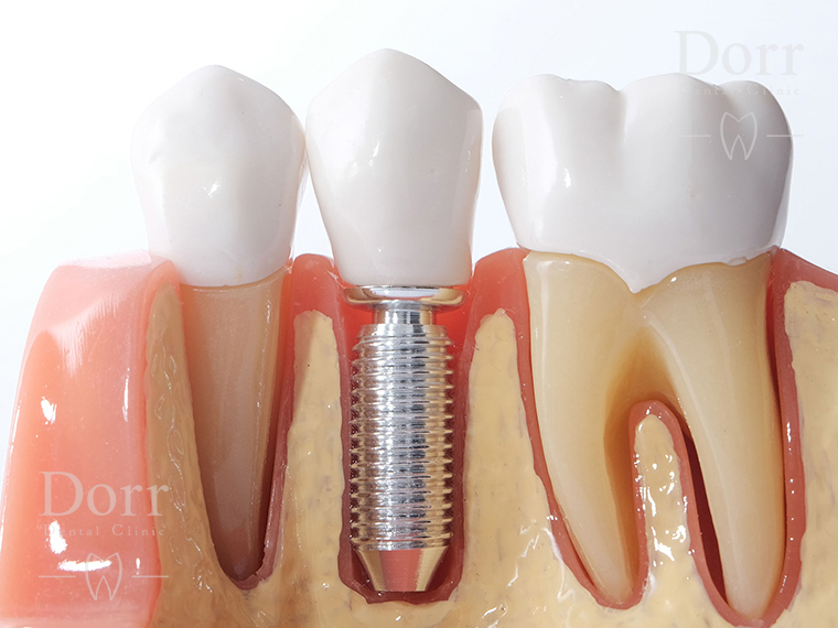 Dental implant