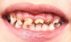 پوسیدگی دندان ها