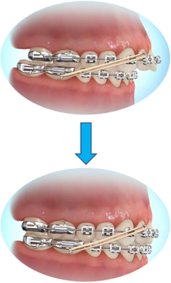 کش ارتودنسی چیست الاستیک ارتودنسی